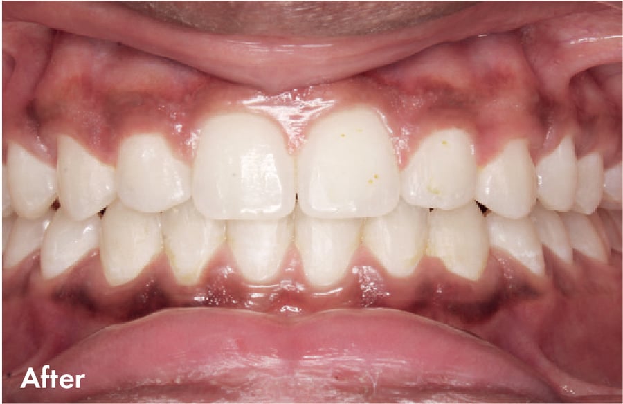 After Clear Correct v3