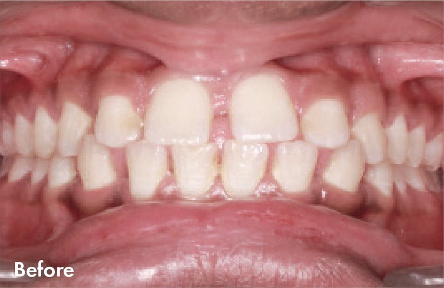 Before Clear Correct v2