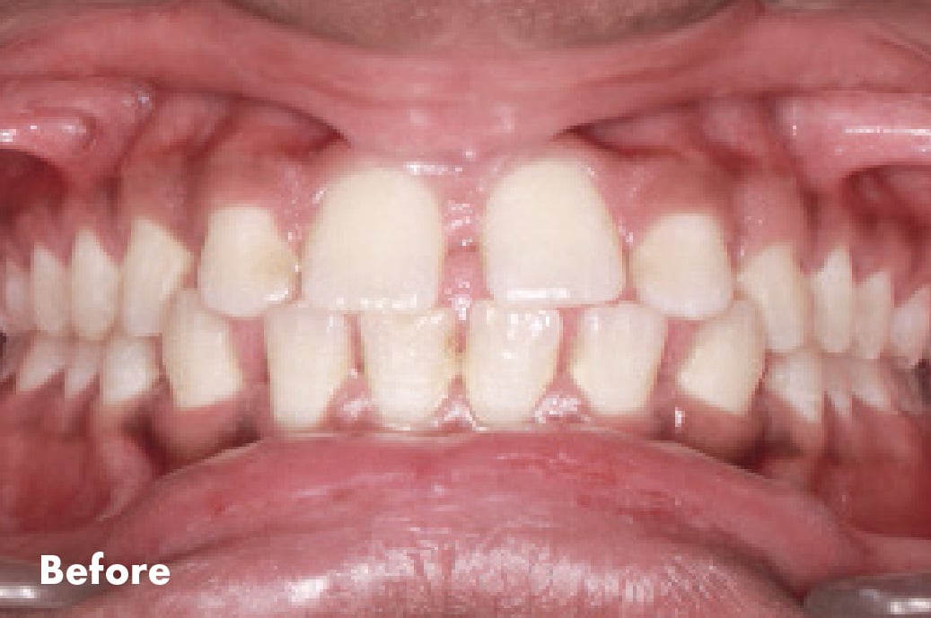 Clear Aligners Before 2