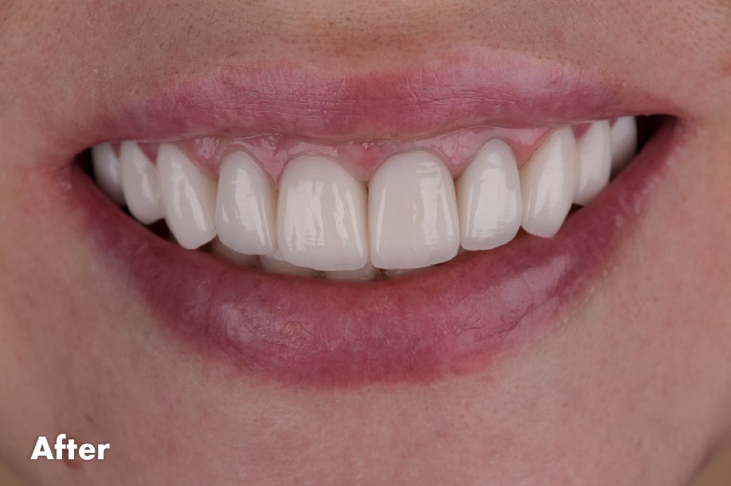 VeneersAfter